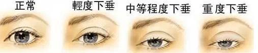 女人眼睛下垂的面相有什么含義,男人下垂有什么說法(圖文)
