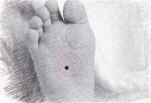 腳底有痣代表什么,腳底有痣到底好不好?