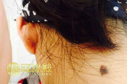 脖子后面有痣代表什么意思你知道嗎(圖文)