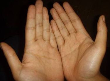 兩只手都是斷掌的男人