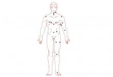 分析痣的好壞如何判定