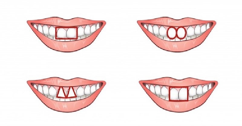 八字形門牙圖片_門牙做烤瓷牙圖片_門牙圖片