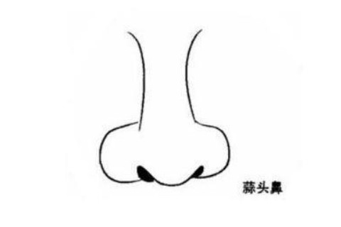 蒜頭鼻的男人怎么樣?