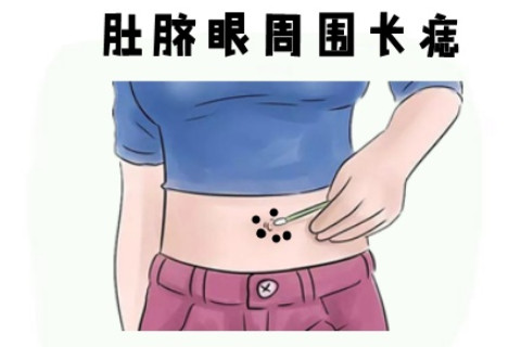 女人生貴子痣長在什么位置