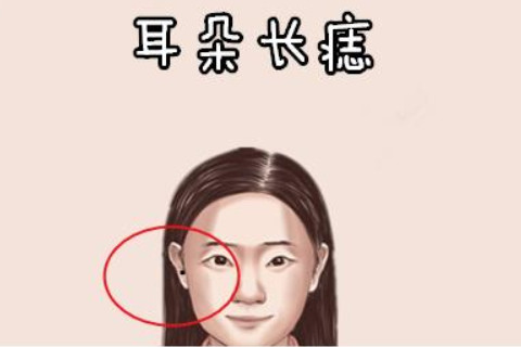 女人耳朵長痣說明了什么?