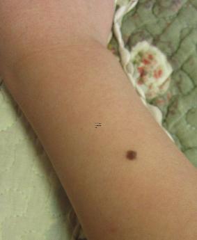 15862-.哪里的痣代表財運 男人財運痣在哪